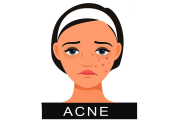 Acne (40)