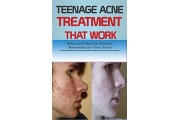 Acne Treatment (33)