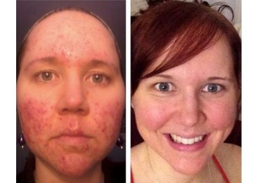 KRISTA’S TOP 5 ACNE GAME CHANGERS