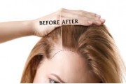 Female Pattern Baldness Treatment (13)