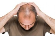 Male Pattern Baldness Treatment (7)
