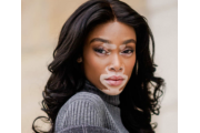 Vitiligo Treatment  (5)