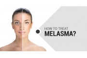 Melasma Treatment (13)