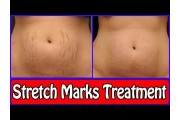 Stretch Marks Treatment (1)